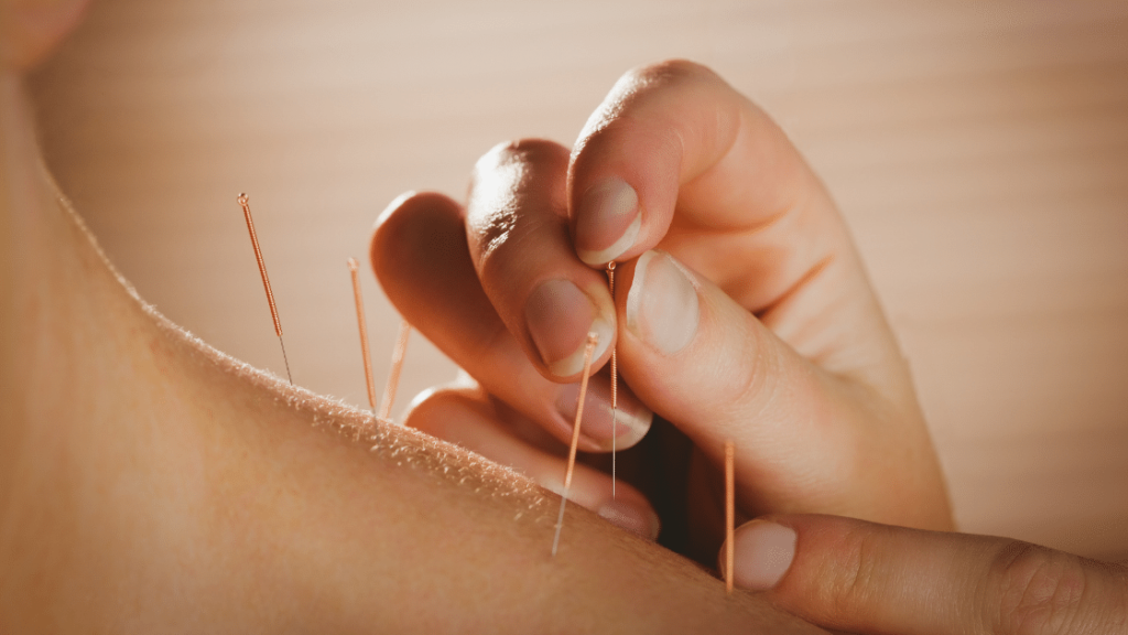 Hand putting in needles for acupuncture for pain in the back