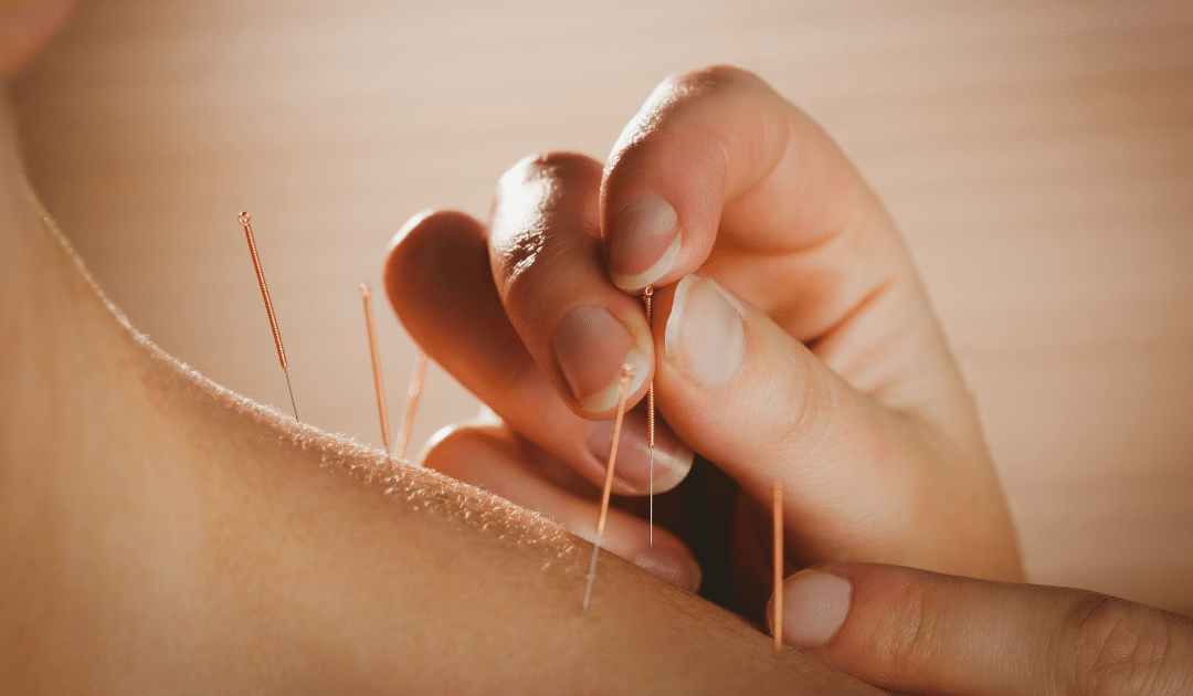 Is Acupuncture Good for Pain?