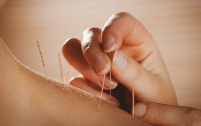 Is Acupuncture Good for Pain?