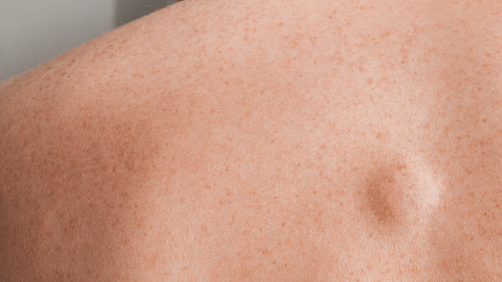 Lipoma on person's back