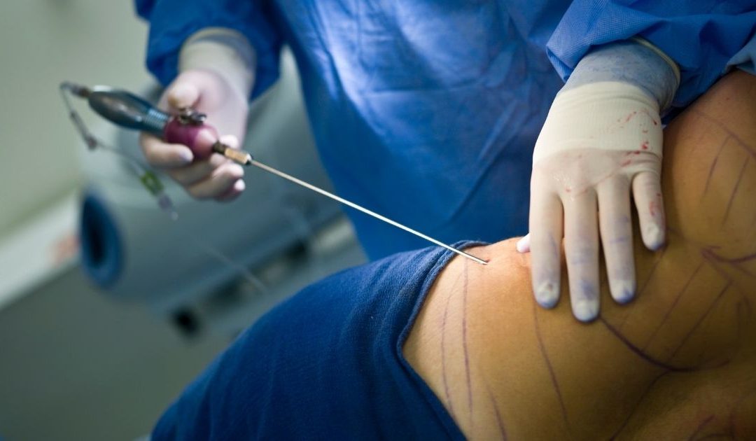 Post-Surgery Massage Part 1: Liposuction