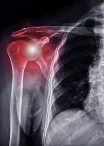 xray of a shoulder lit up in red to indicate where the pain is