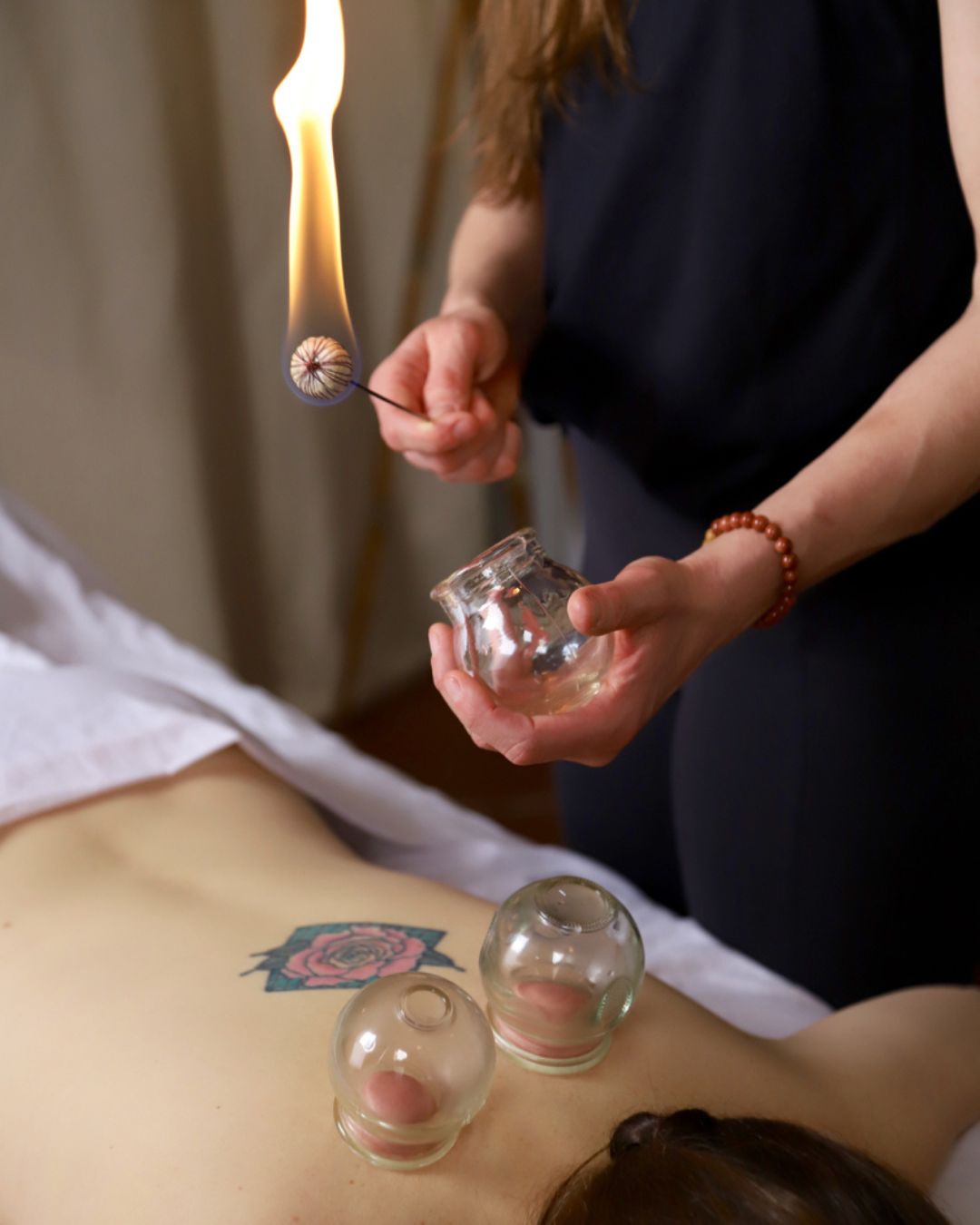 fire cupping on patients back during acupuncture follow-up appointment