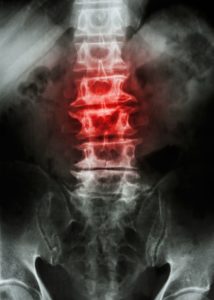 Spondylosis spine xray