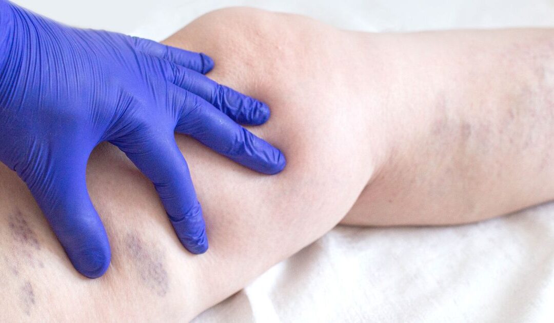 Oncology Massage and Deep Vein Thrombosis: Is It Safe?