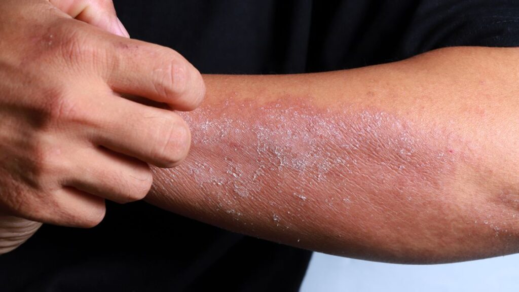 person scratching itchy eczema on a forearm
