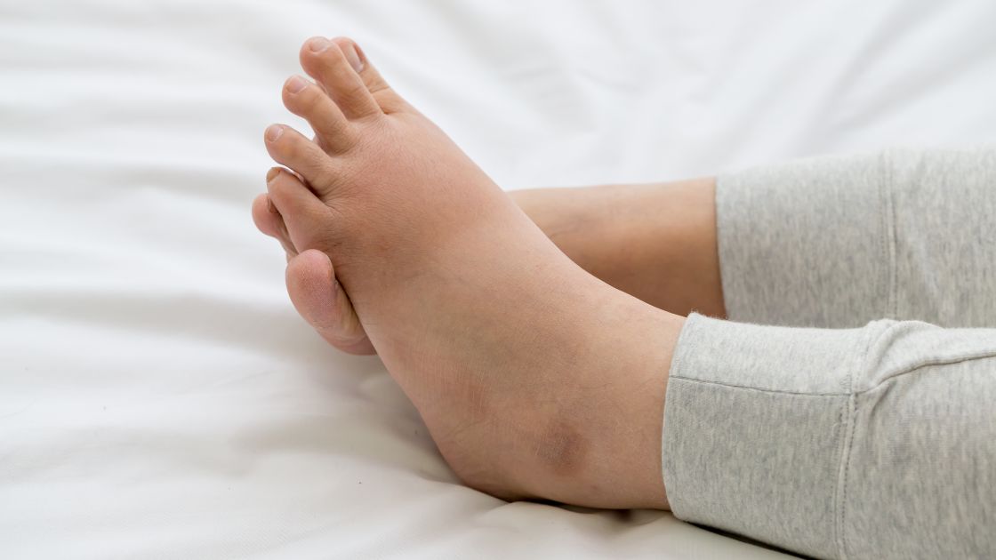 swollen feet on a bed