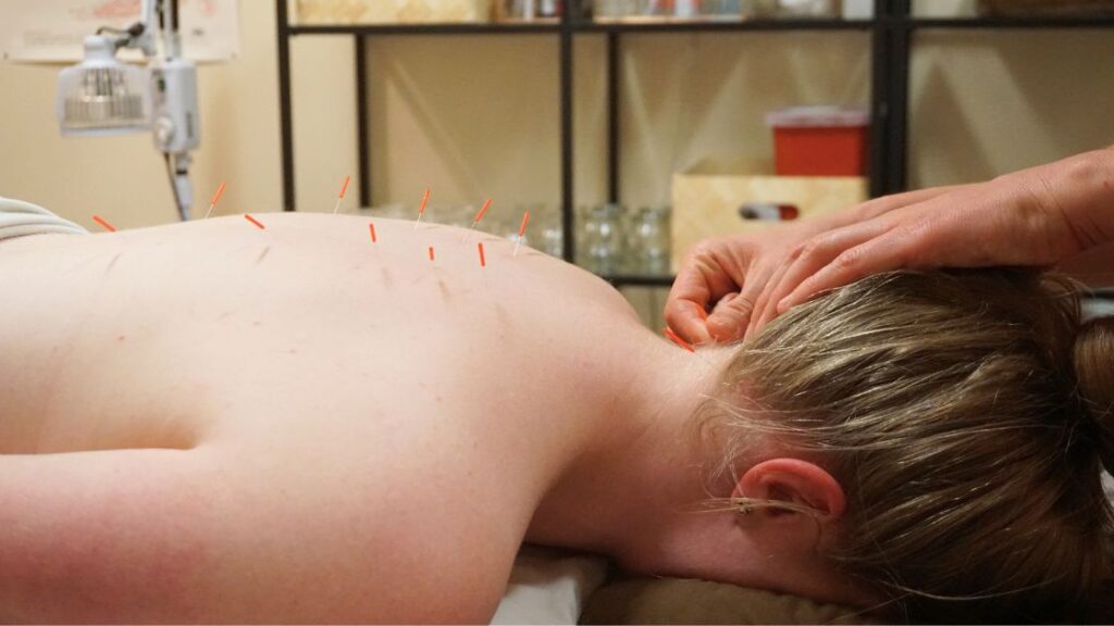 BH – Massage and Acupuncture (2) female patient receiving acupuncture on her back and neck